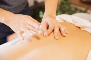 Person receiving dry-needling treatment from physiotherapist